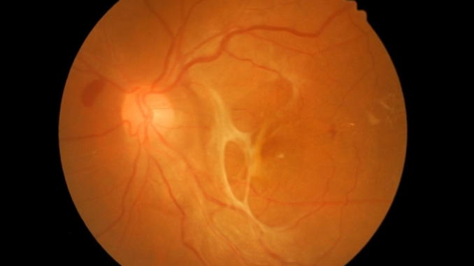 Penting untuk ada paham mengenai seluk beluk penyakit ablasio retina