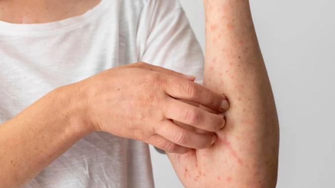 mengenal penyakit Raja Singa penyebab serta gejala penyakit ini antara lain gejala tahap primer sekunder tersier hingga gejala pada pria dan wanita.