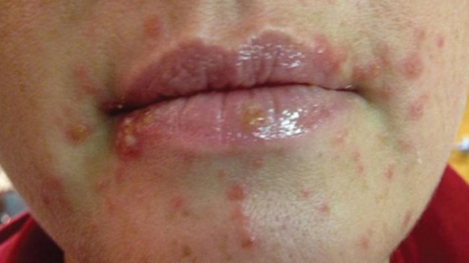 Mengenal Ini Penyakit Raja Singa, Gejala Hingga Penyebabnya