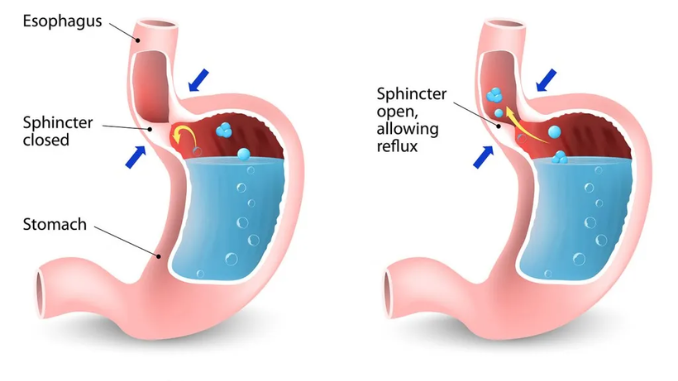 Ketahui Berikut Ini Perbedaan Antara Penyakit Maag dan GERD